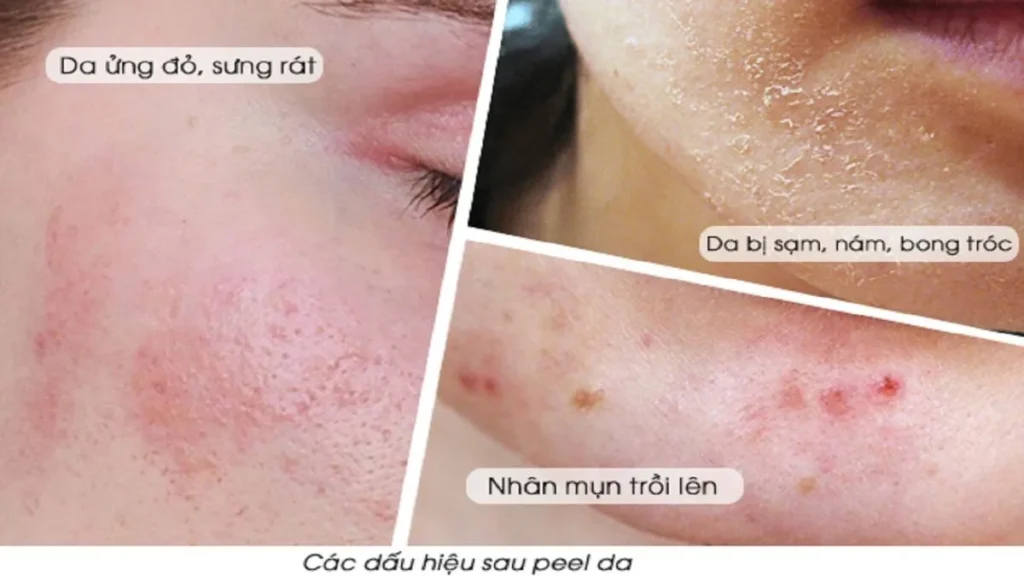Dưỡng Ẩm Đúng Cách: Chăm Da Sau Peel Laser 3 chăm sóc da sau peel