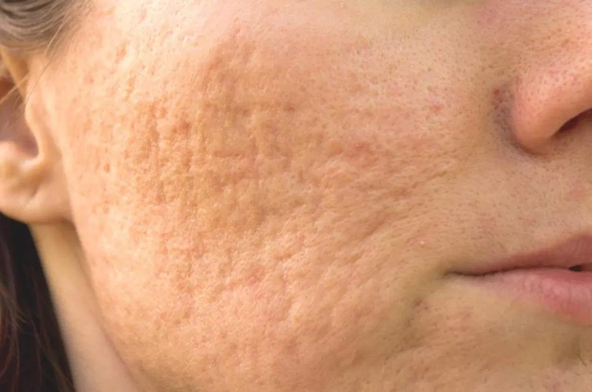 khách bị sẹo rỗ lâu năm