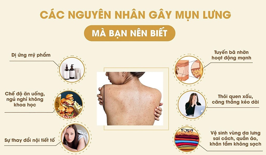 Điều trị mụn lưng như thế nào? Nguyên nhân – cách khắc phục hiệu quả 2 cac nguyen nhan gay mun lung