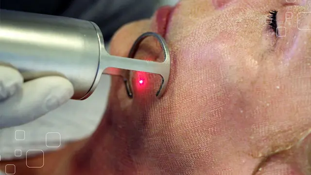 Giải pháp điều trị sẹo rỗ chuyên sâu: từ TCA đến Laser Fractional CO₂ 4 Laser Fractional CO₂ tại spa fresh banana