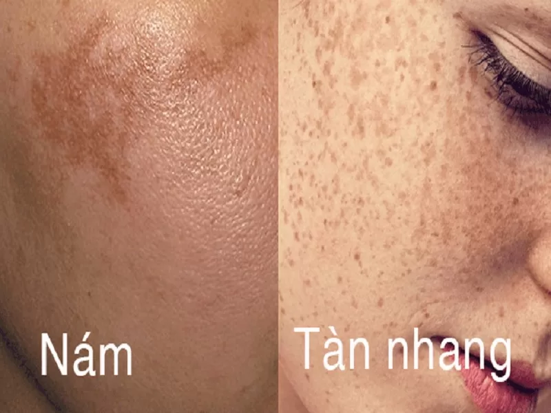 Nám Tàn Nhang: Phân Biệt Nguyên Nhân và Cơ Chế Tái Phát 2 nam va tan nhang jpg