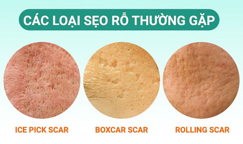 Giải pháp điều trị sẹo rỗ chuyên sâu: từ TCA đến Laser Fractional CO₂ 2 phan loai seo ro