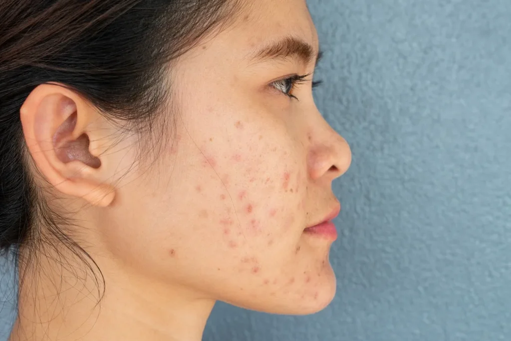 Nguyên Nhân Mụn Thâm Và Cách Phòng Ngừa Tái Thâm Hiệu Quả 1 khach hàng bị mụn thâm lâu năm