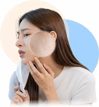 Các loại sẹo rỗ phổ biến trên da mặt