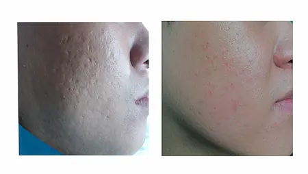 Kết quả điều trị sẹo rỗ thành công cho khách hàng nữ tại Fresh Banana Spa Gò Vấp