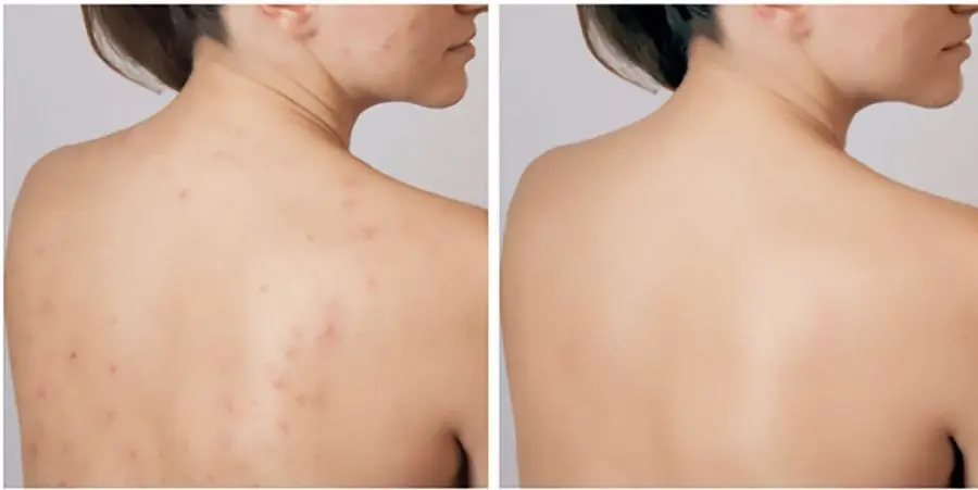 peel da lung dieu tri mun lung