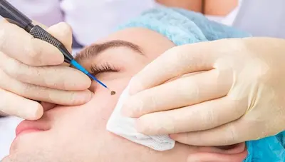 Thiết bị Laser CO2 hiện đại dùng trong điều trị nốt ruồi, mụn thịt