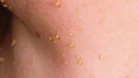 Mụn thịt vùng cổ và ngực