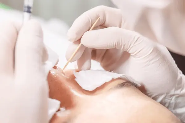 Giải pháp điều trị sẹo rỗ chuyên sâu: từ TCA đến Laser Fractional CO₂ 3 Hiệu quả sau điều trị sẹo rỗ bằng TCA tại Fresh Banana Spa