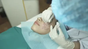 Làn da bị sẹo rỗ trước khi điều trị tại Fresh Banana