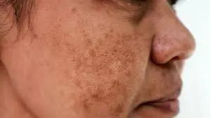 Tình trạng nám da và tàn nhang thường gặp ở phụ nữ