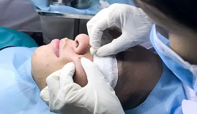 Phương pháp bóc tách và laser trị sẹo rỗ tại Fresh Banana Spa