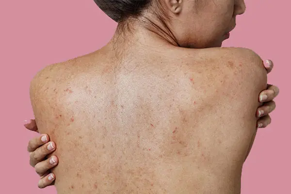 phan loai mun lung 4 cap do