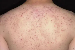 điều trị mụn lưng thế nào