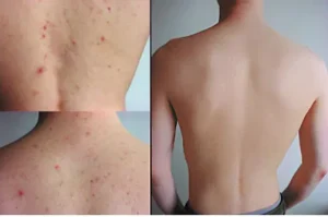 hinh anh ket qua dieu tri mun lung