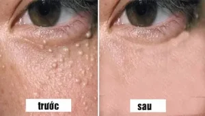 Mụn thịt quanh mắt – biểu hiện thường gặp