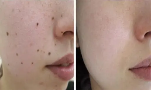 Hình ảnh khách hàng trước và sau điều trị nốt ruồi bằng Laser tại Spa Fresh Banana