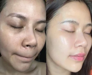 hình ảnh trước sau tiem meso spa fresh banana gò vấp