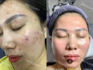 hình ảnh khách hàng tiem meso tại spa fresh banana gò vấp