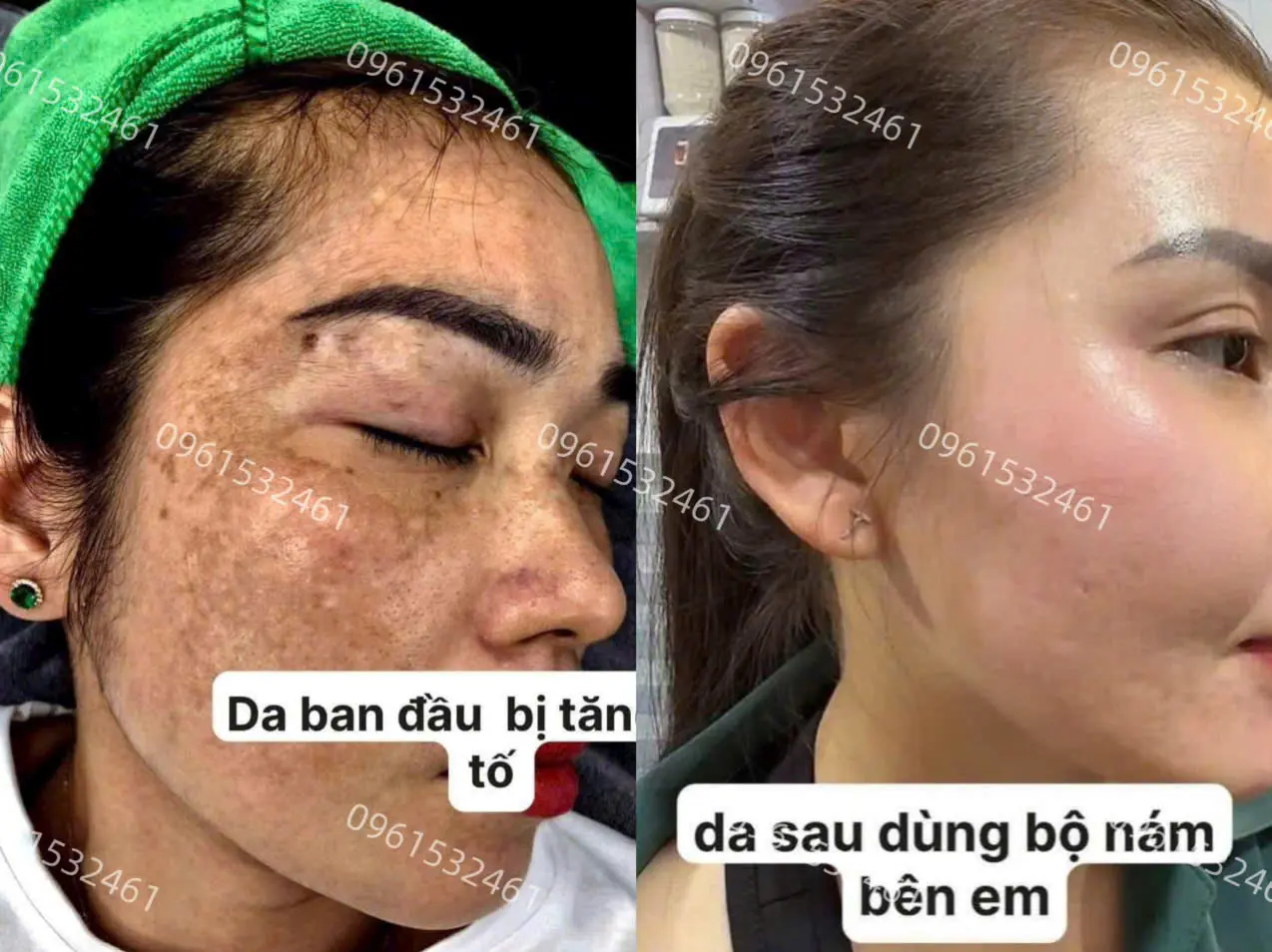 khách peel da trị nám thành công tại spa fresh banana gò vấp