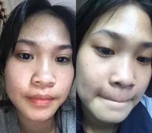 trị mụn thâm fresh banana gò vấp