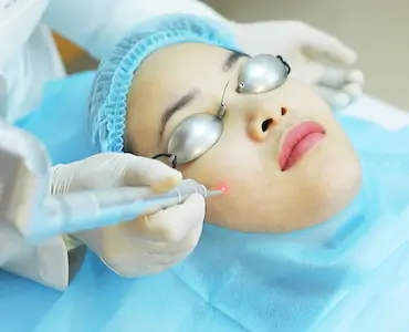 Điều trị nốt ruồi, mụn thịt bằng Laser CO2 tại Spa Fresh Banana Gò Vấp