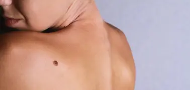 Nốt ruồi sắc tố trên da mặt và thân người