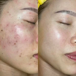 Trước và sau điều trị nốt ruồi, mụn thịt tại Fresh Banana Gò Vấp