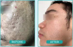Hình ảnh before after điều trị sẹo rỗ tại Fresh Banana Spa
