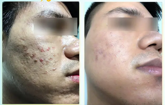 Giải pháp điều trị sẹo rỗ chuyên sâu: từ TCA đến Laser Fractional CO₂ 6 Trị sẹo rỗ cho nam giới tại Fresh Banana Spa Gò Vấp