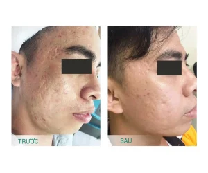 hình ảnh trước sau điều trị sẹo rỗ spa fresh banana gò vấp