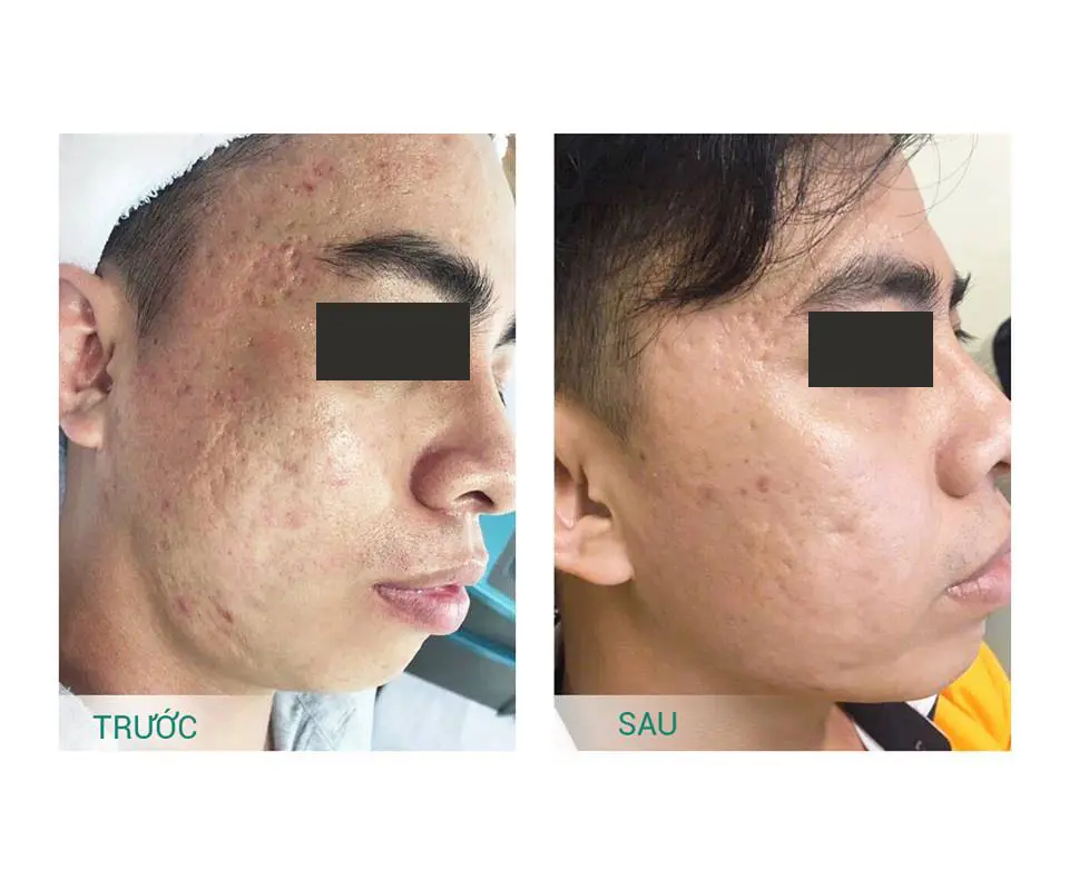 hình ảnh trước sau trị sẹo rỗ spa fresh banana gò vấp