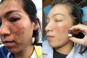 Hình ảnh khách hàng sau khi trị sẹo rỗ bằng công nghệ TCA tại Fresh Banana Spa