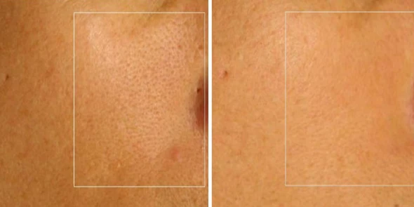 Hiệu quả thực tế của Laser Fractional CO2
