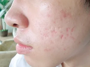 sẹo rỗ sau mụn