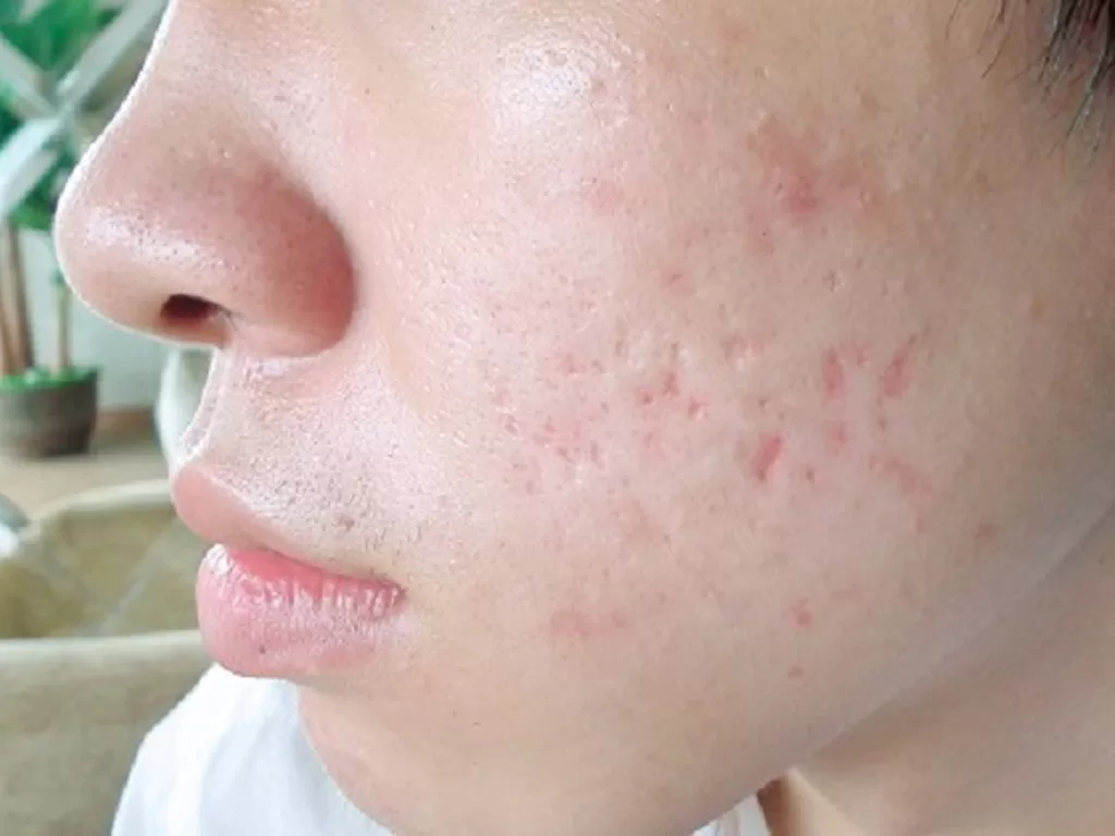 sẹo rỗ sau mụn